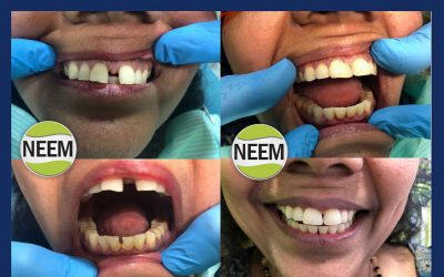Improving the aesthetics of the upper anterior teeth