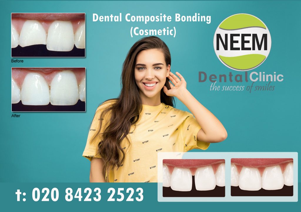 Dental Composite Bonding (Cosmetic) | Neem Dental Clinic | Harrow