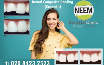 Dental Composite Bonding (Cosmetic) | Neem Dental Clinic | Harrow