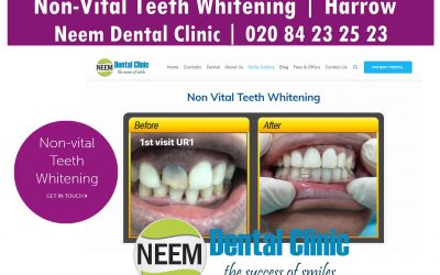 Non-Vital Front Tooth: What Should I Do Now? (Dental Treatment Options)