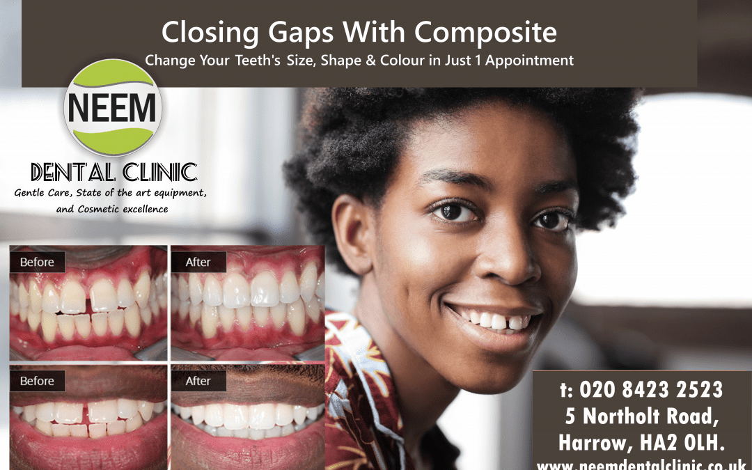 Composite Bonding Treatment In Harrow | Rayners Lane | Sudbury | Sudbury Hill | Wembley | We’re Here For You!