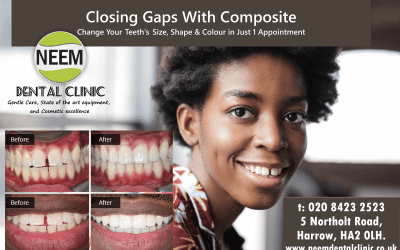 Composite Bonding Treatment In Harrow | Rayners Lane | Sudbury | Sudbury Hill | Wembley | We’re Here For You!