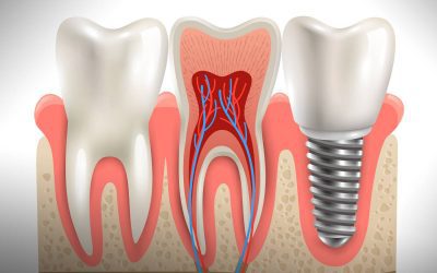 Time to Equip Knowledge About Different Types of Dental Implants