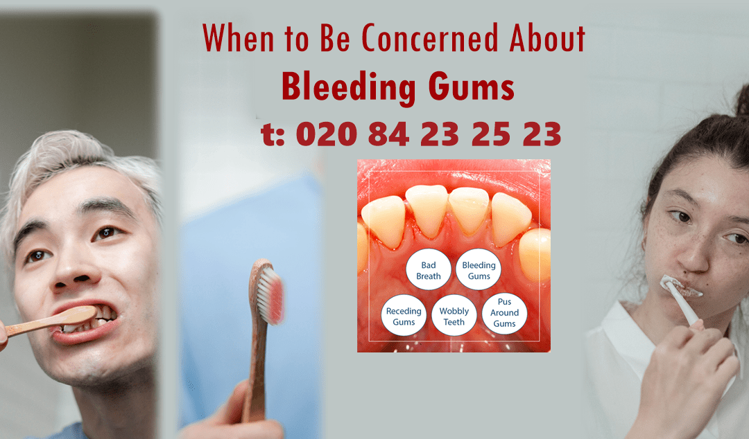 Stop Bleeding Gums