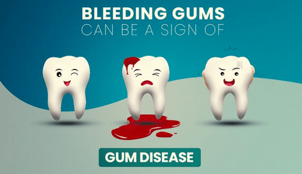 Stop Bleeding Gums